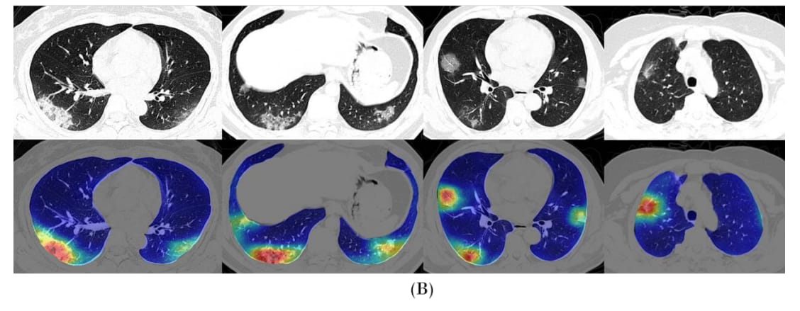 CT-Image-coronoavirus-deeplearning